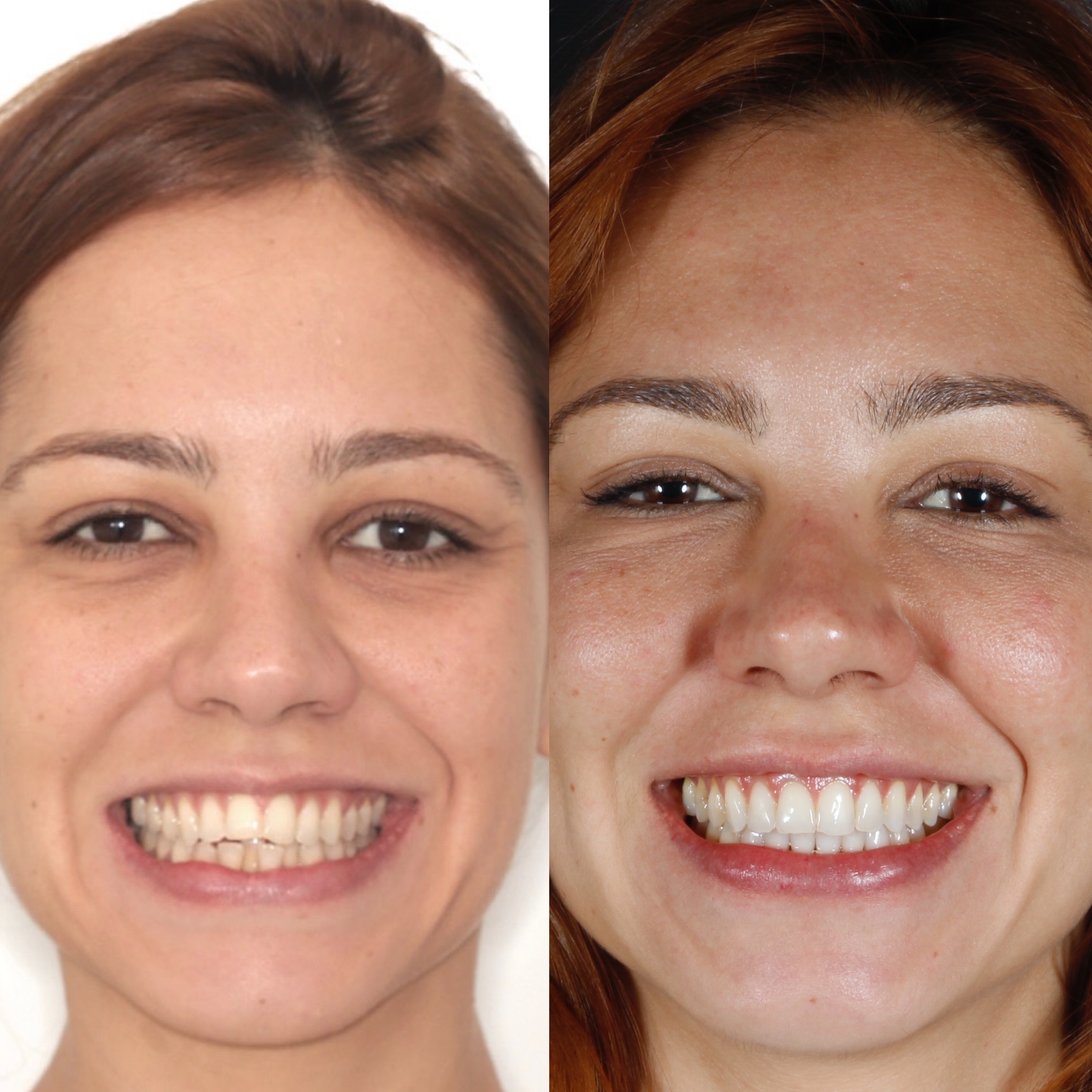 Comparação do sorriso de uma paciente antes e depois do tratamento