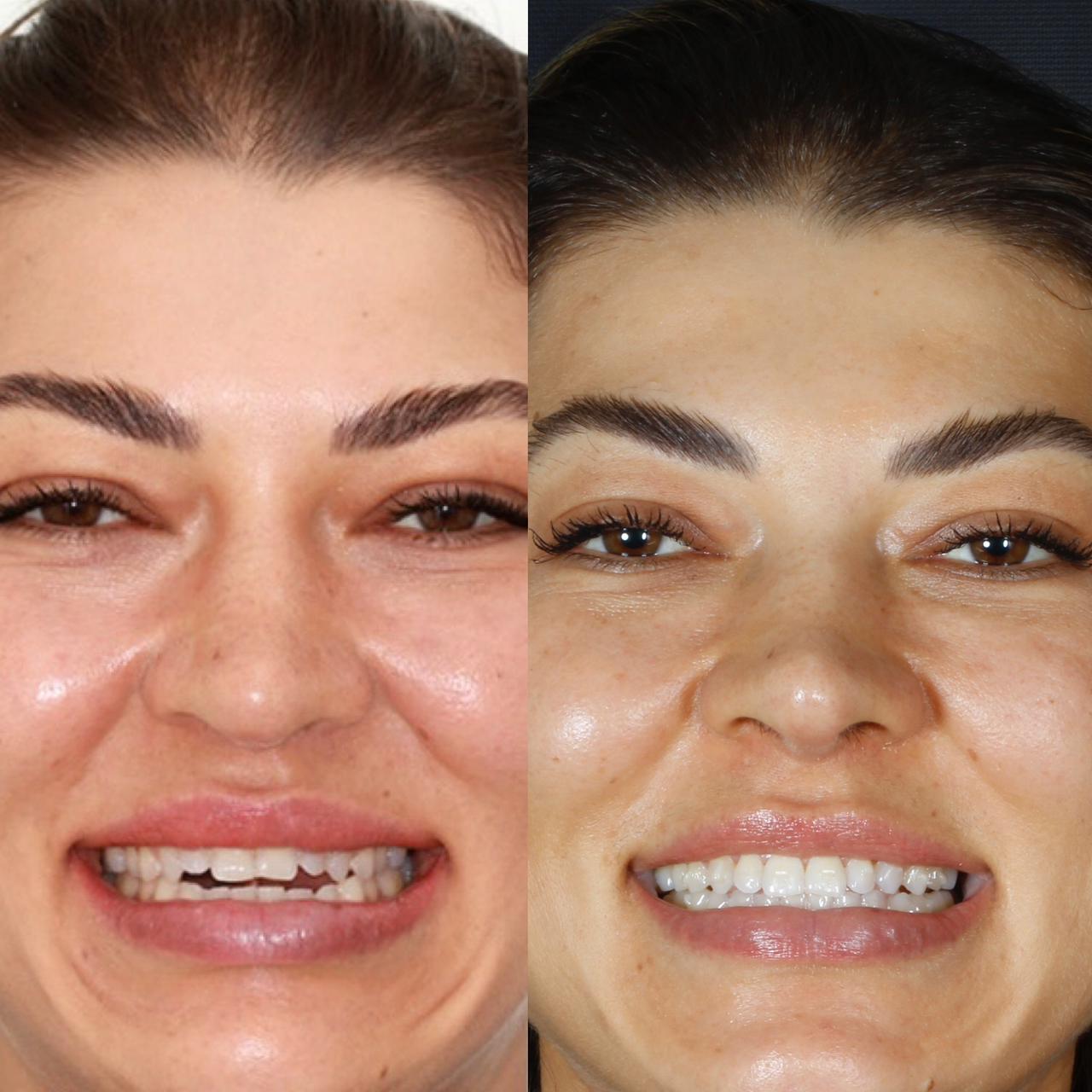 Comparação do sorriso de uma paciente antes e depois do tratamento