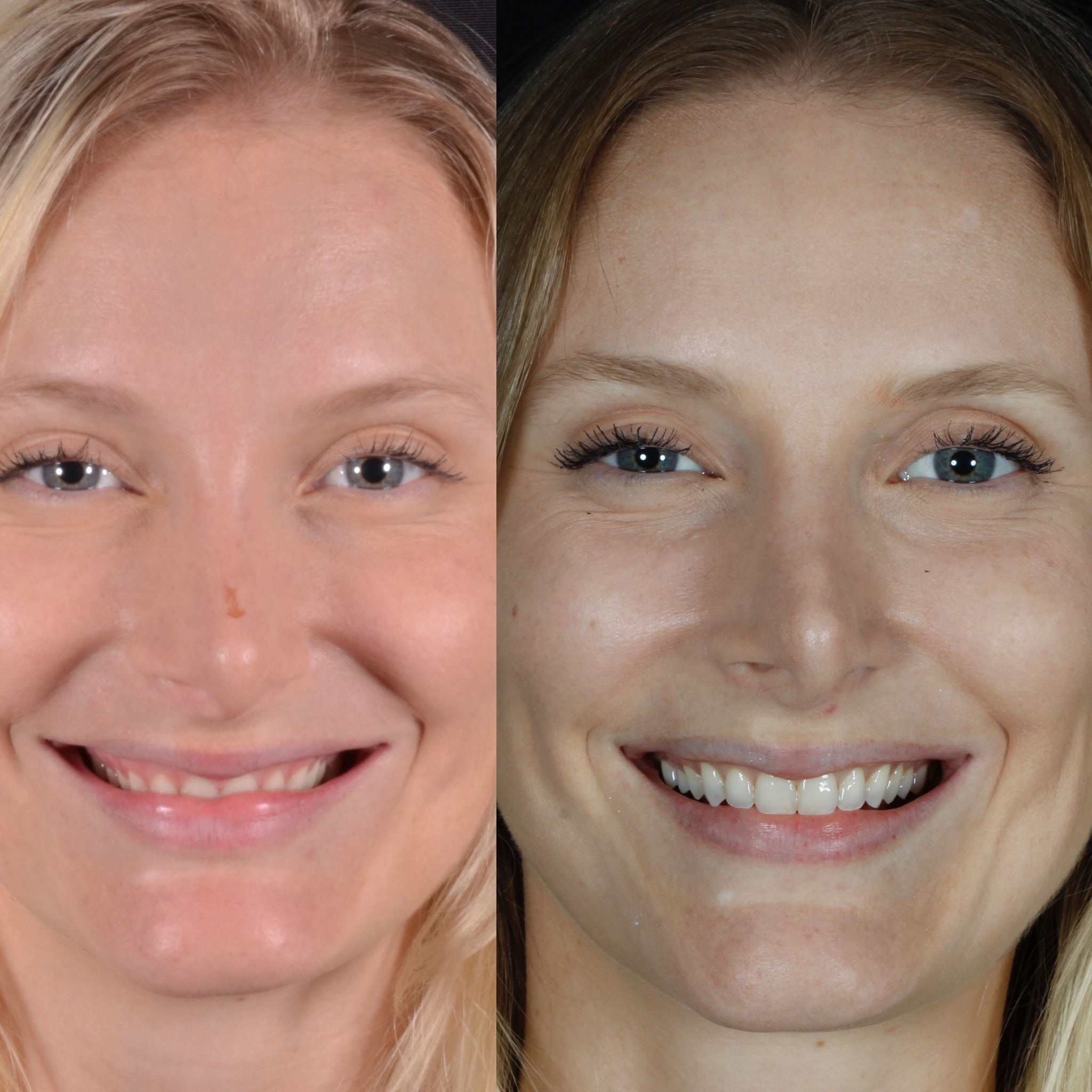 Comparação do sorriso de uma paciente antes e depois do tratamento