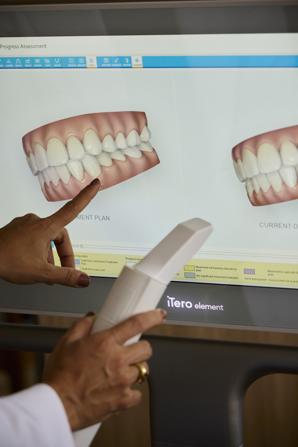 Escaneamento intraoral realizado durante a consulta
